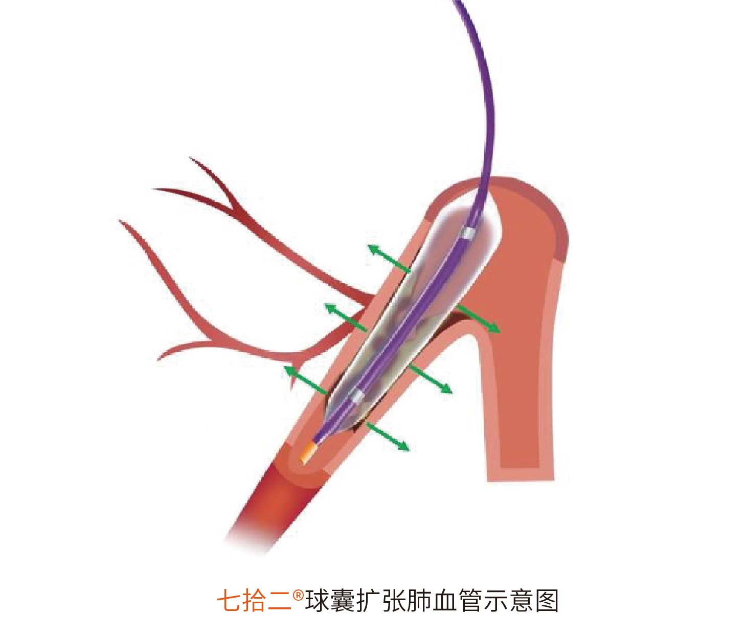 七拾二?Sev-changes 肺動脈球囊擴(kuò)張導(dǎo)管(圖2)