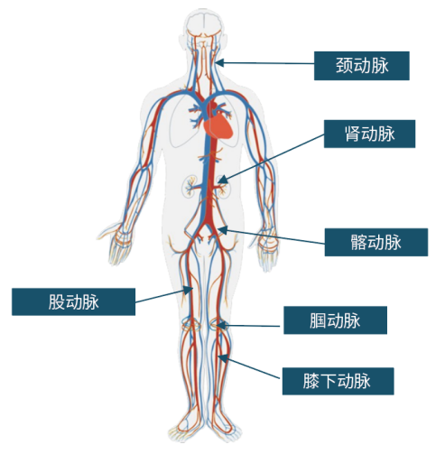 祿游?Luvjour 外周球囊擴(kuò)張導(dǎo)管(圖2)